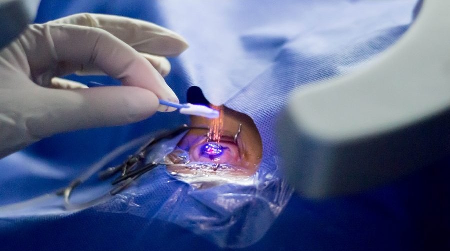 Procedimiento de cirugía refractiva con láser